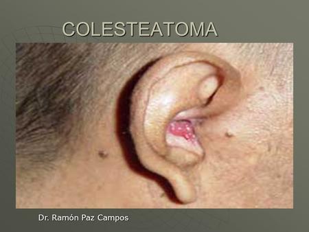 COLESTEATOMA Dr. Ramón Paz Campos.