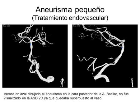 Aneurisma pequeño (Tratamiento endovascular)