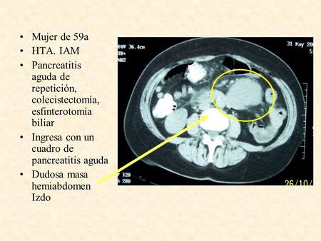 Mujer de 59a HTA. IAM Pancreatitis aguda de repetición, colecistectomía, esfinterotomía biliar Ingresa con un cuadro de pancreatitis aguda Dudosa masa.