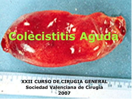 Colecistitis Aguda XXII CURSO DE CIRUGIA GENERAL Sociedad Valenciana de Cirugía 2007.