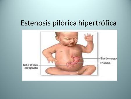 Estenosis pilórica hipertrófica