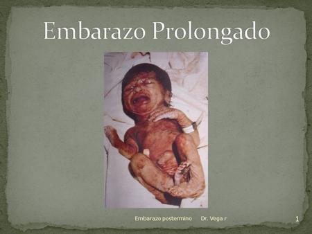 Embarazo Prolongado Embarazo postermino Dr. Vega r.