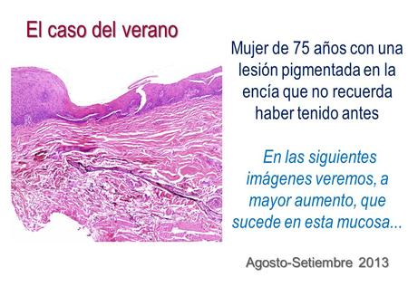 Mujer de 75 años con una lesión pigmentada en la encía que no recuerda haber tenido antes En las siguientes imágenes veremos, a mayor aumento, que sucede.