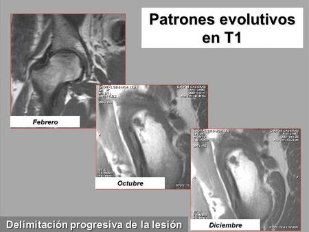 Patrones evolutivos en T1 Febrero Octubre Diciembre Delimitación progresiva de la lesión.