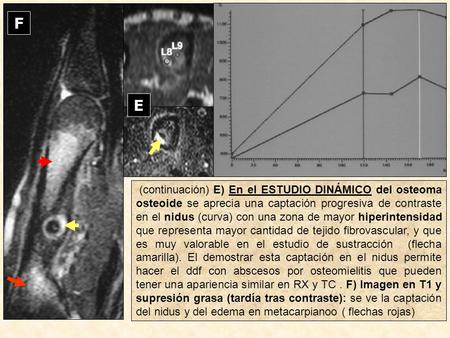 E F L8 L9 (continuación) E) En el ESTUDIO DINÁMICO del osteoma osteoide se aprecia una captación progresiva de contraste en el nidus (curva) con una zona.