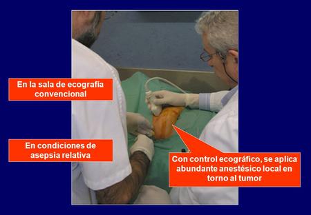Con control ecográfico, se aplica abundante anestésico local en torno al tumor En la sala de ecografía convencional En condiciones de asepsia relativa.