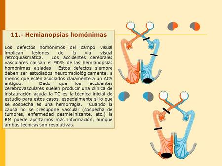 11.- Hemianopsias homónimas