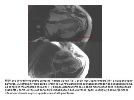 RNM eco de gradiente cuatro cámaras (“sangre blanca”) (a) y espín-eco (“sangre negra”) (b), ambas en cuatro cámaras. Muestran a nivel de cara lateral medioventricular.