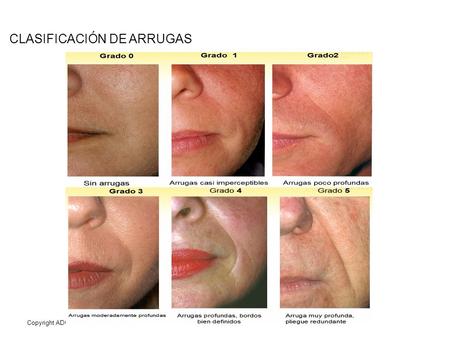CLASIFICACIÓN DE ARRUGAS