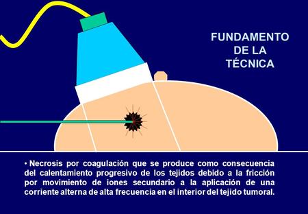 Necrosis por coagulación que se produce como consecuencia del calentamiento progresivo de los tejidos debido a la fricción por movimiento de iones secundario.