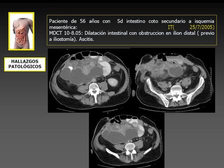 Paciente de 56 años con Sd intestino coto secundario a isquemia mesentérica: IT( 25/7/2005) MDCT 10-8.05: Dilatación intestinal con obstruccion en ilion.