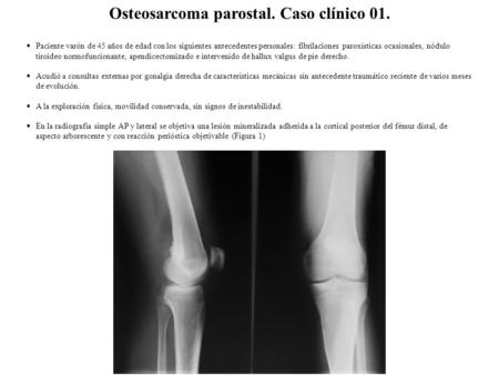  Paciente varón de 45 años de edad con los siguientes antecedentes personales: fibrilaciones paroxísticas ocasionales, nódulo tiroideo normofuncionante,