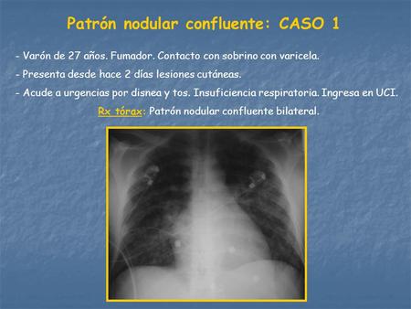 Patrón nodular confluente: CASO 1