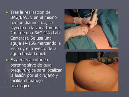 Tras la realización de BAG/BAV, y en el mismo tiempo diagnóstico, se inyecta en la zona tumoral 2 ml de una SAC 4% (Lab. Carreras). Se usa una aguja 14-16G.