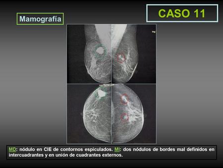 CASO 11 Mamografía MD: nódulo en CIE de contornos espiculados. MI: dos nódulos de bordes mal definidos en intercuadrantes y en unión de cuadrantes externos.