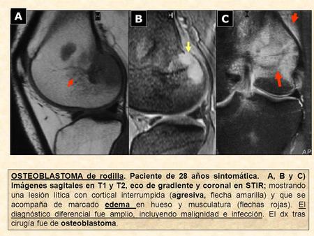 A B C OSTEOBLASTOMA de rodilla. Paciente de 28 años sintomática. A, B y C) Imágenes sagitales en T1 y T2, eco de gradiente y coronal en STIR; mostrando.