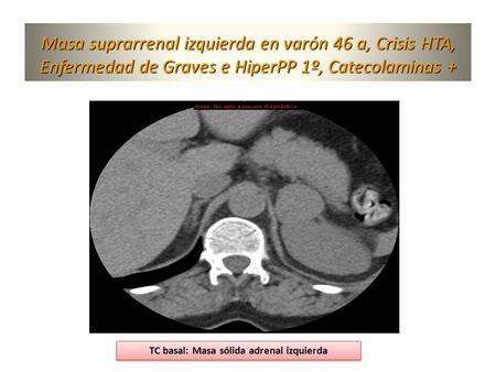 Masa suprarrenal izquierda en varón 46 a, Crisis HTA, Enfermedad de Graves e HiperPP 1º, Catecolaminas + TC basal: Masa sólida adrenal izquierda.