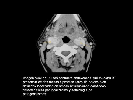 Imagen axial de TC con contraste endovenoso que muestra la presencia de dos masas hipervasculares de bordes bien definidos localizadas en ambas bifurcaciones.