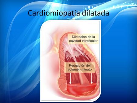Cardiomiopatía dilatada