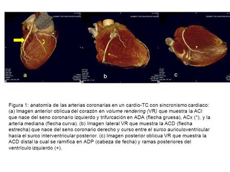 A b c * + Figura 1: anatomía de las arterias coronarias en un cardio-TC con sincronismo cardiaco: (a) Imagen anterior oblicua del corazón en volume rendering.
