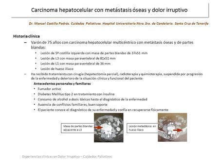 Carcinoma hepatocelular con metástasis óseas y dolor irruptivo