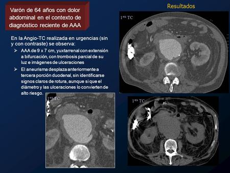 Resultados Varón de 64 años con dolor abdominal en el contexto de diagnóstico reciente de AAA 1era TC En la Angio-TC realizada en urgencias (sin y con.