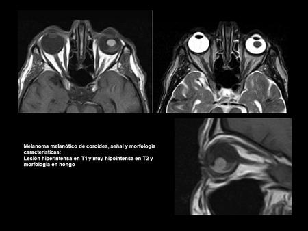 Melanoma melanótico de coroides, señal y morfología