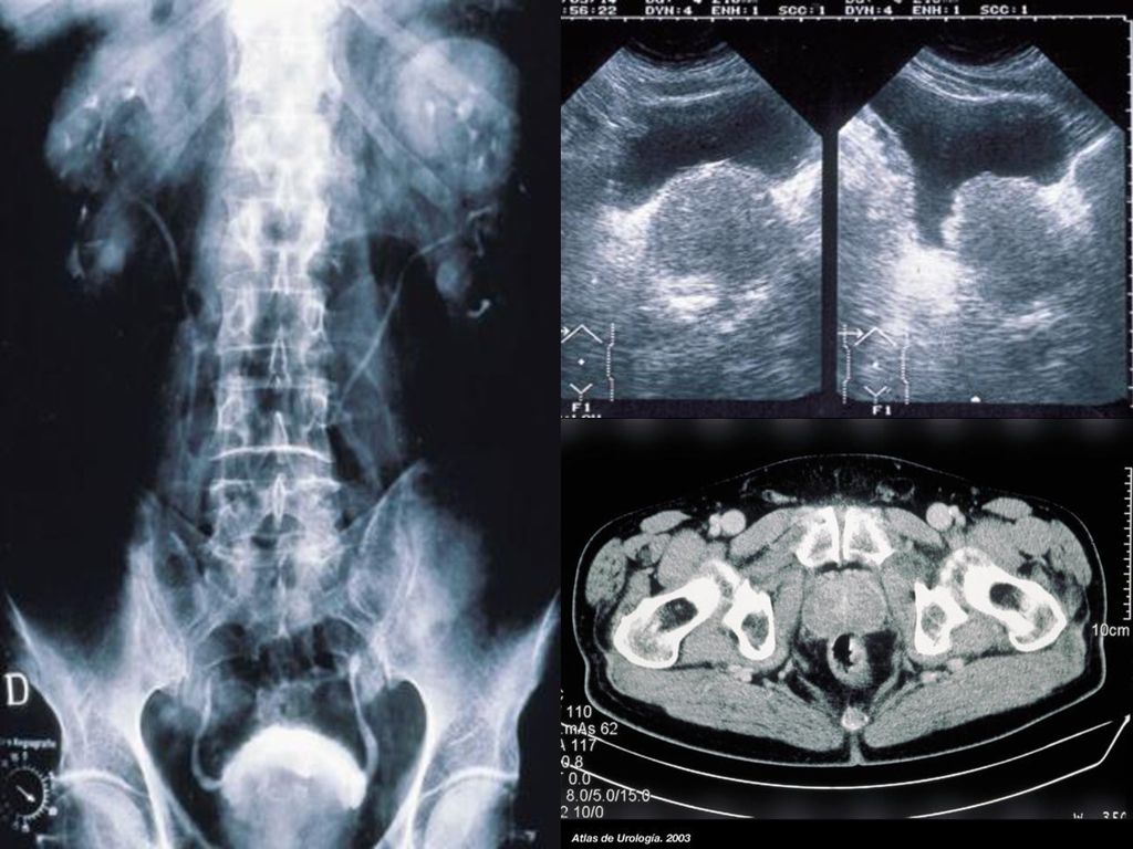 Простатоцистит. Рентген предстательной железы. Аденома предстательной железы на рентгене. Гиперплазия предстательной железы рентген.