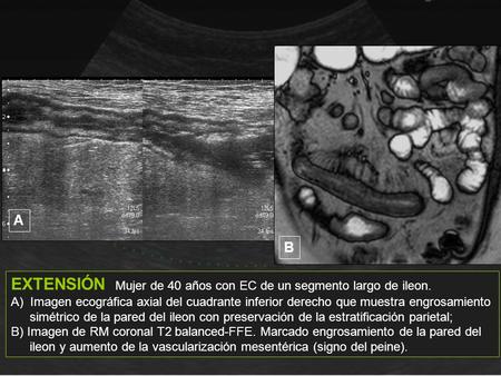 EXTENSIÓN Mujer de 40 años con EC de un segmento largo de ileon.