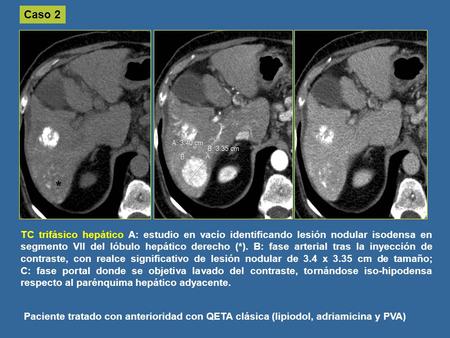 Caso 2 * TC trifásico hepático A: estudio en vacío identificando lesión nodular isodensa en segmento VII del lóbulo hepático derecho (*). B: fase arterial.