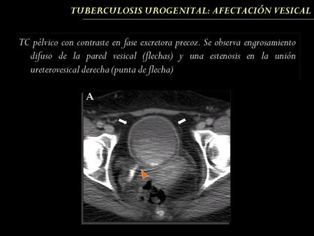 TUBERCULOSIS UROGENITAL: AFECTACIÓN VESICAL