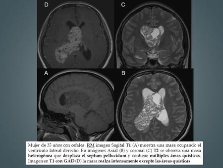 D C A B B Mujer de 35 años con cefalea. RM imagen Sagital T1 (A) muestra una masa ocupando el ventrículo lateral derecho. En imágenes Axial (B) y coronal.
