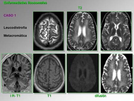 Enfermedades lisosomales