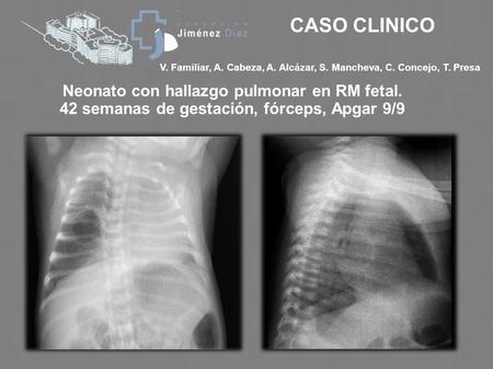 CASO CLINICO Neonato con hallazgo pulmonar en RM fetal.