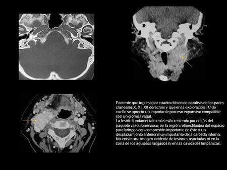 Paciente que ingresa por cuadro clínico de parálisis de los pares craneales X, XI, XII derechos y que en la exploración TC de cuello se aprecia un importante.