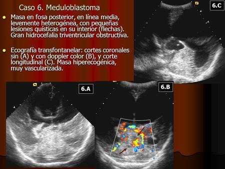 Caso 6. Meduloblastoma 6.C Masa en fosa posterior, en línea media, levemente heterogénea, con pequeñas lesiones quísticas en su interior (flechas). Gran.