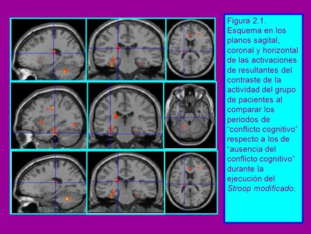 Figura 2.1. Esquema en los planos sagital, coronal y horizontal de las activaciones de resultantes del contraste de la actividad del grupo de pacientes.