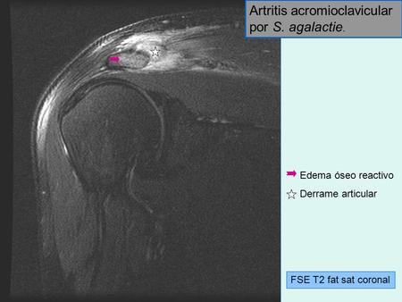 Artritis acromioclavicular por S. agalactie.