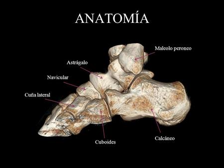 ANATOMÍA Maleolo peroneo Astrágalo Navicular Cuña lateral Calcáneo