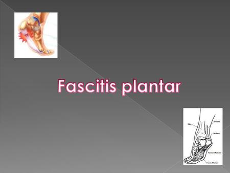 Fascitis plantar.