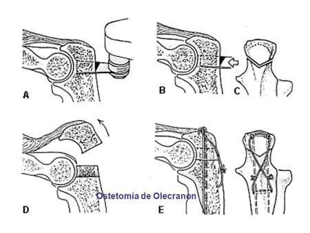 Ostetomia de Olecranon