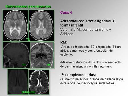 Adrenoleucodistrofia ligada al X, forma infantil