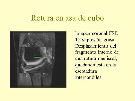 Rotura en asa de cubo Imagen coronal FSE T2 supresión grasa. Desplazamiento del fragmento interno de una rotura meniscal, quedando este en la escotadura.