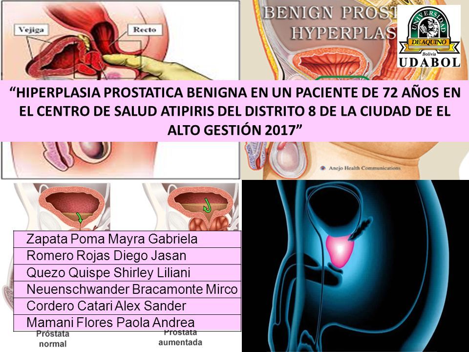 hiperplasia adenomatosa de próstata