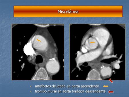 Miscelánea artefactos de latido en aorta ascendente