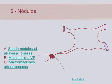 6.- Nódulos Seudo nódulos al atravesar cisuras B. Metástasis a VP