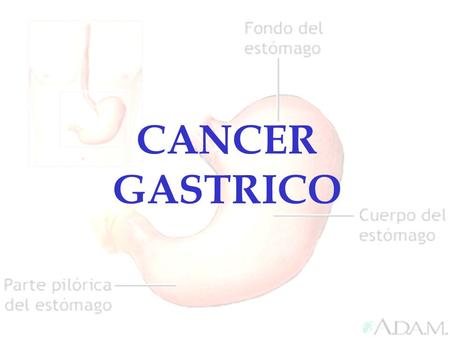 CANCER GASTRICO.