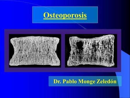 Osteoporosis Dr. Pablo Monge Zeledón.