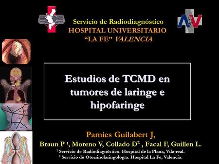 Estudios de TCMD en tumores de laringe e hipofaringe