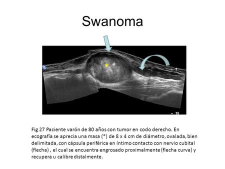 Swanoma * Fig 27 Paciente varón de 80 años con tumor en codo derecho. En ecografía se aprecia una masa (*) de 8 x 4 cm de diámetro, ovalada, bien delimitada,